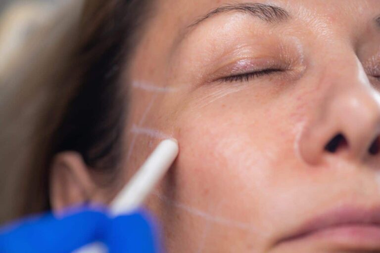 Thread lifting as a gentle alternative to surgical facelift.